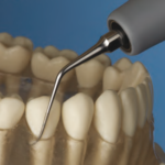 PUNTAS PARA PIEZO #2LD,DIAMANTE IZQUIERDO,US2LD,HU-FRIEDY - Imagen 3
