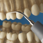 PUNTAS PARA PIEZO EMS,#S10,UNIV.,UES10,HU-FRIEDY - Imagen 3