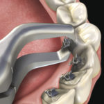 ALICATES 703 LINGUAL REMOVEDOR DE BRACKET,678-703, HU-FRIEDY - Imagen 2